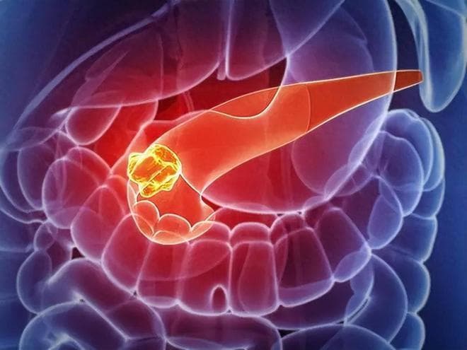 称为“沉默杀手”的恶性肿瘤，胰腺癌怎么回事？远离7个风险因素
