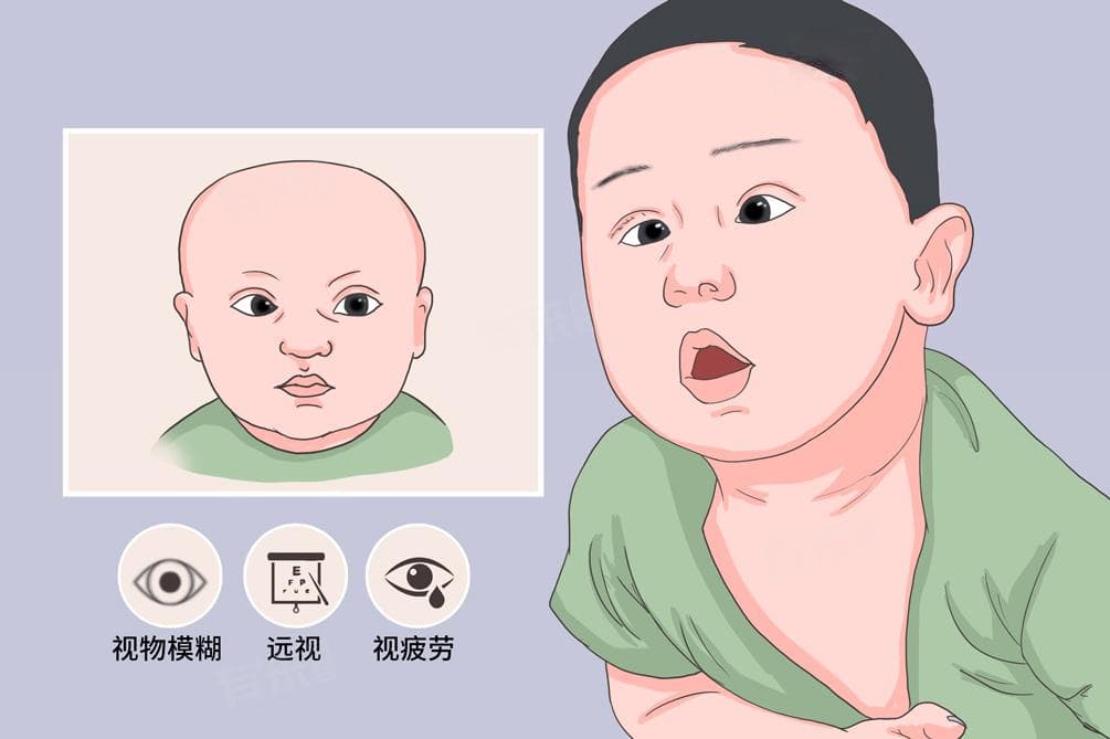 斗鸡眼能矫正过来吗