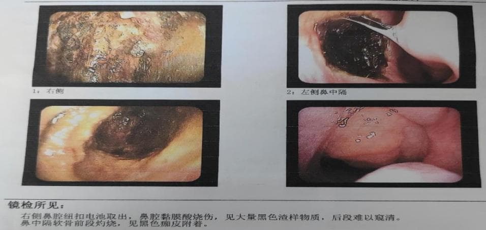 福建一男童流鼻血、发高烧，“元凶”每家都在用！医生：严重者可引发全身中毒