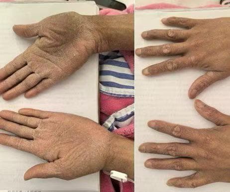 女子长期吃牛黄解毒片后“砒霜”中毒……医生紧急提醒
