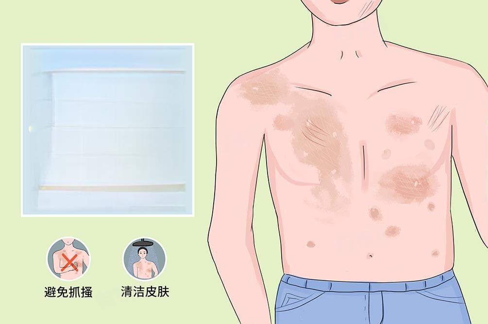 马拉色菌会传染别人吗