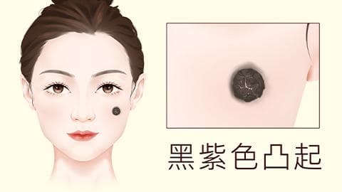 痣的良性与恶性如何判断