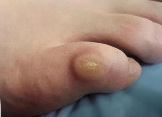 去除脚上的鸡眼， 用什么办法更好？