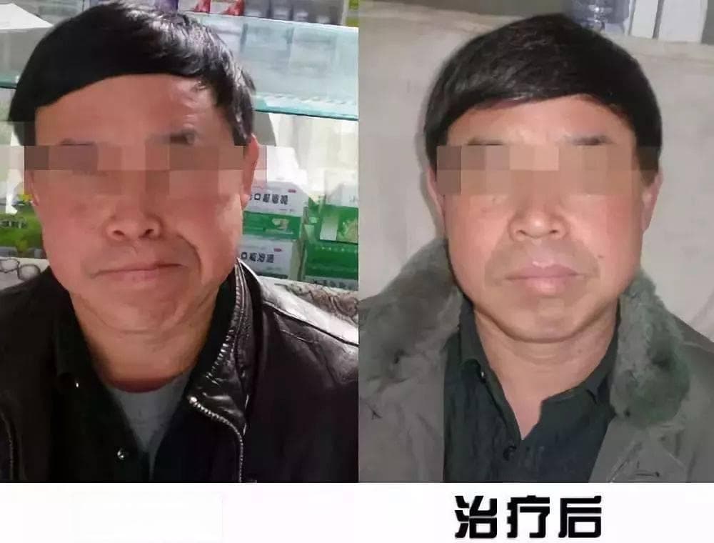 面瘫康复：表情肌康复训练8步法，动图演示