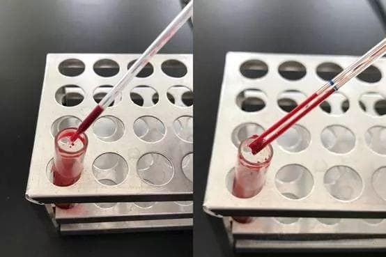 非常规操作：血液湿片2秒辨真假血小板减少！