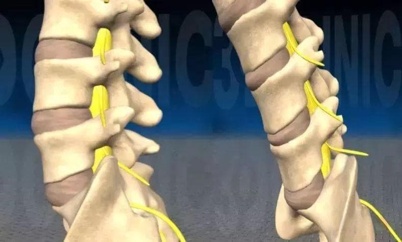 最全！腰椎间盘突出症诊断与治疗