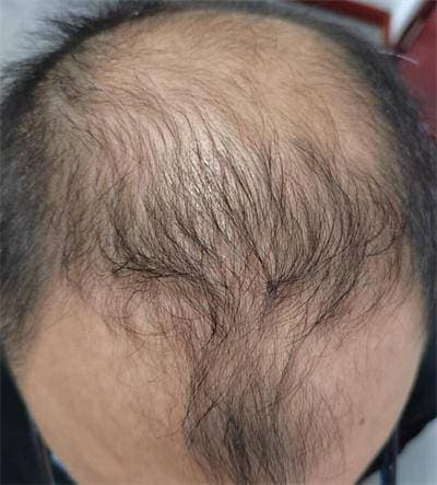 男性脱发真相大揭秘：如何拯救头发不再稀疏！