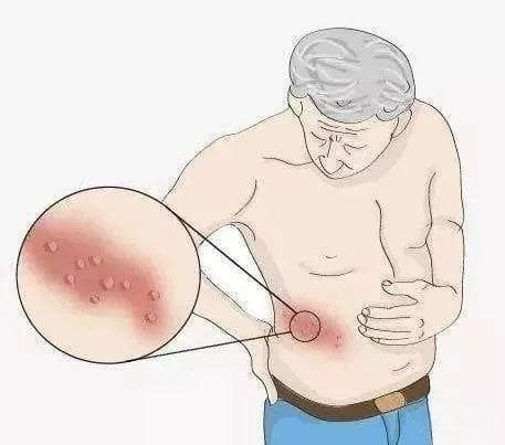 带状疱疹来袭，你了解它的真面目吗？