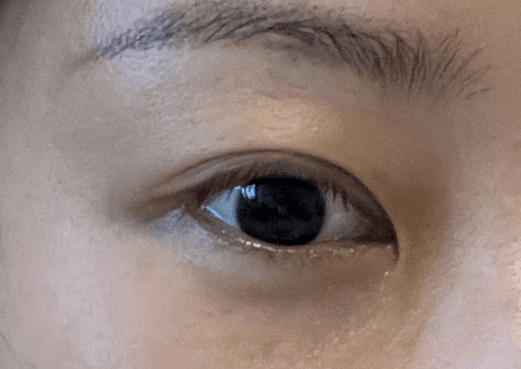 近视手术做好还是带眼镜好？