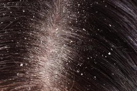 头皮屑问题的全面调理与健康解析