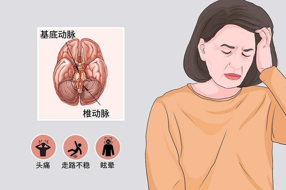 基底动脉开窗畸形需要治疗吗？一文读懂病情处理方案