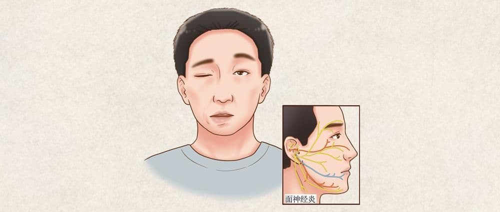 一觉睡醒，嘴歪眼斜？医生：秋季高发！