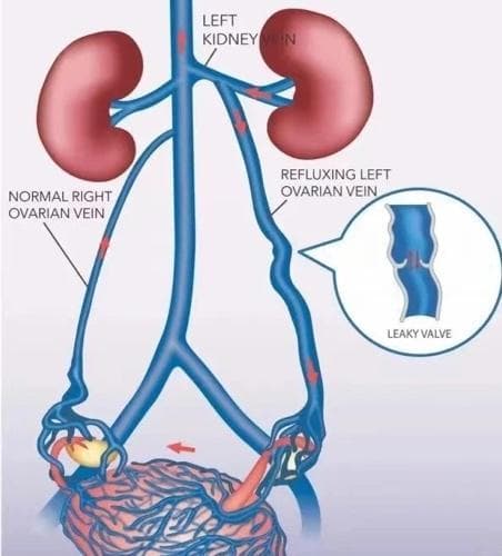 腿上青筋暴起，罪魁祸首竟是髂静脉压迫综合征