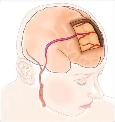 "人工前交通动脉"治疗症状性大脑前动脉A2段闭塞