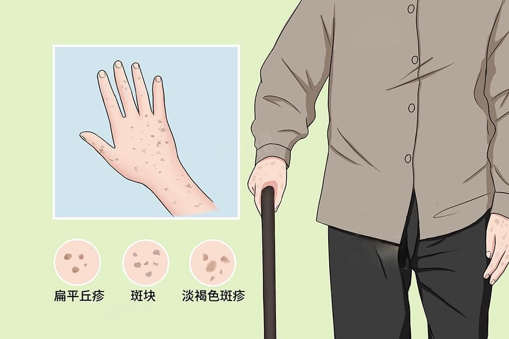 老人斑是什么原因？脂溢性角化病的成因与治疗方法