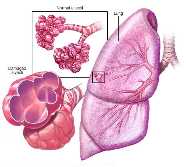 慢性阻塞性肺疾病（COPD）：症状、病因与预防