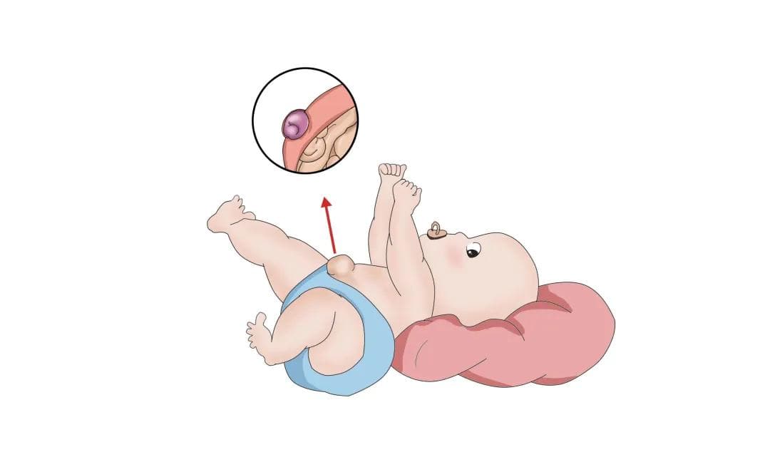 【健康科普】肚脐突出来，当心是脐疝在作怪