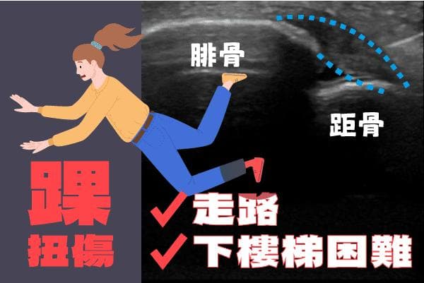 脚踝扭伤分級与处理方法：从轻微到严重，如何正确应对？
