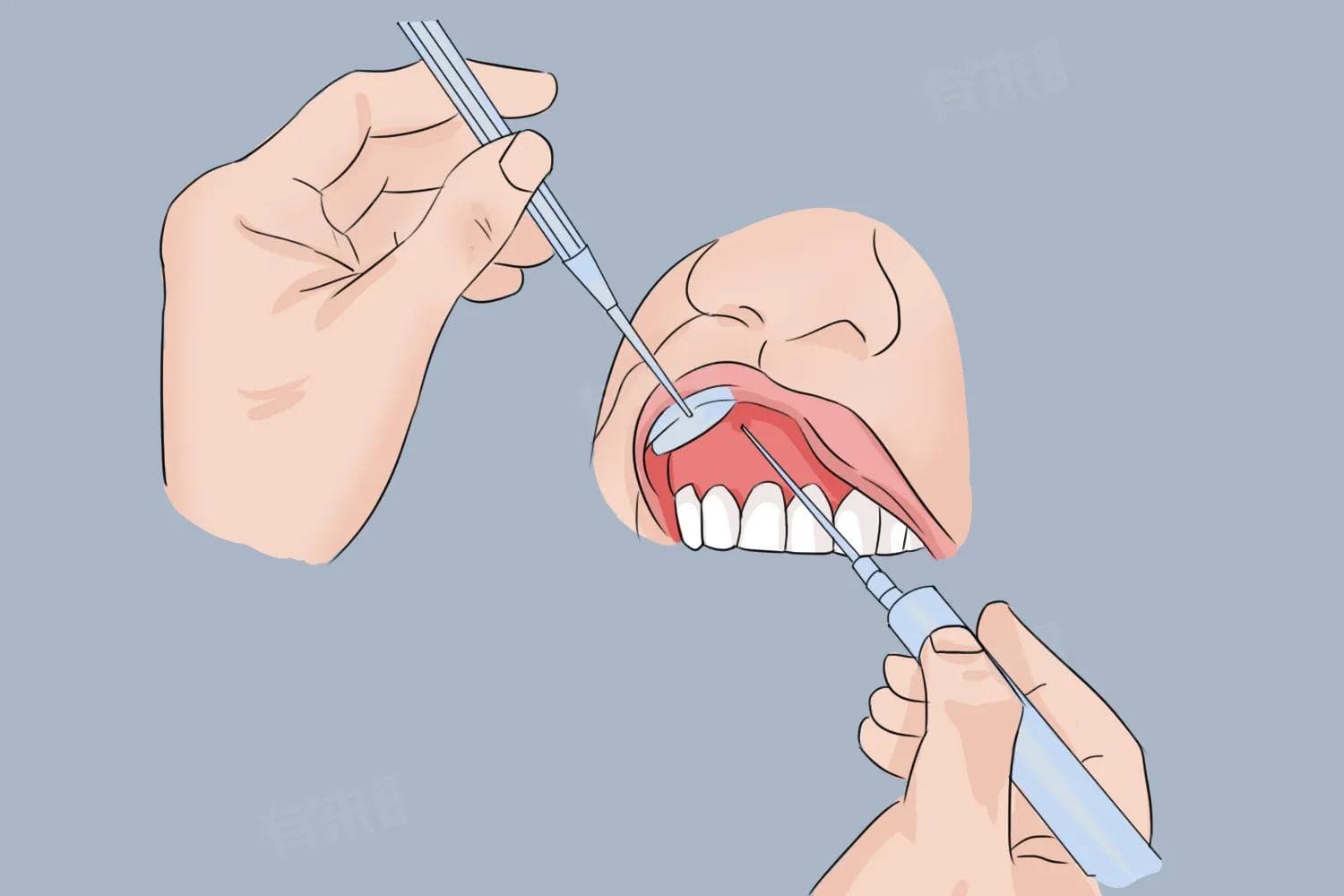 牙齿根尖炎怎么治疗最有效