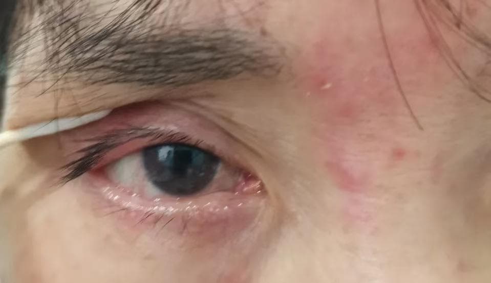 女孩反复眼红流泪，竟是这种常见眼病！医生提醒：这些症状要警惕