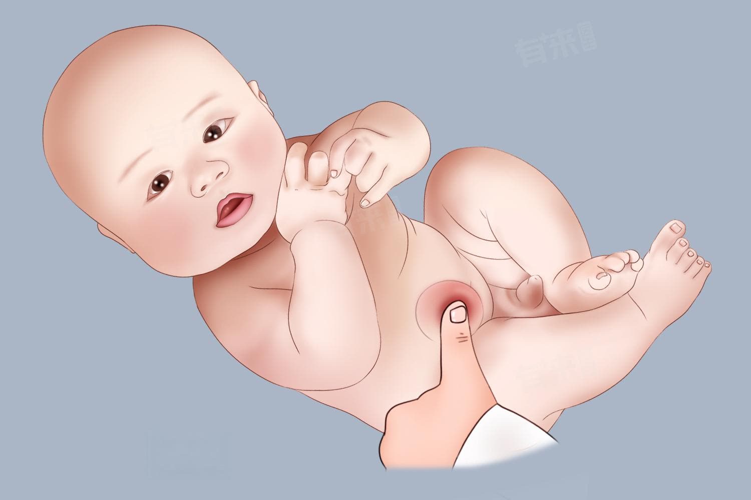 小孩子腹股沟疝是怎么回事