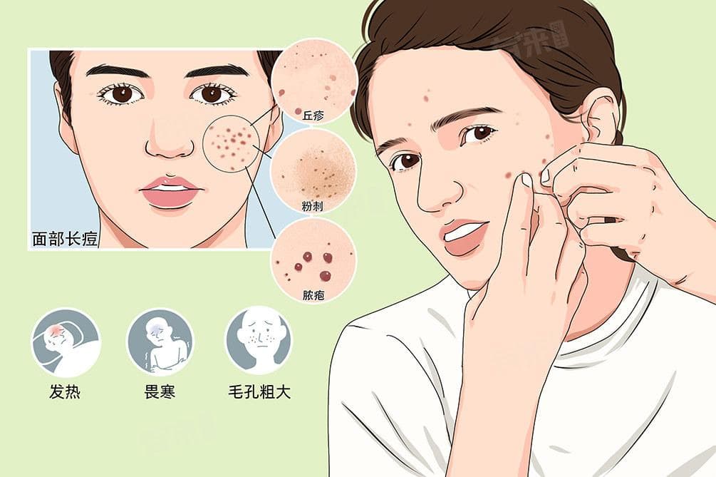 面部痤疮的治疗方法有哪些