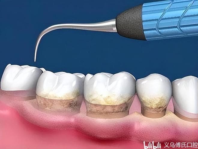 牙结石预防指南：5个实用方法守护口腔健康