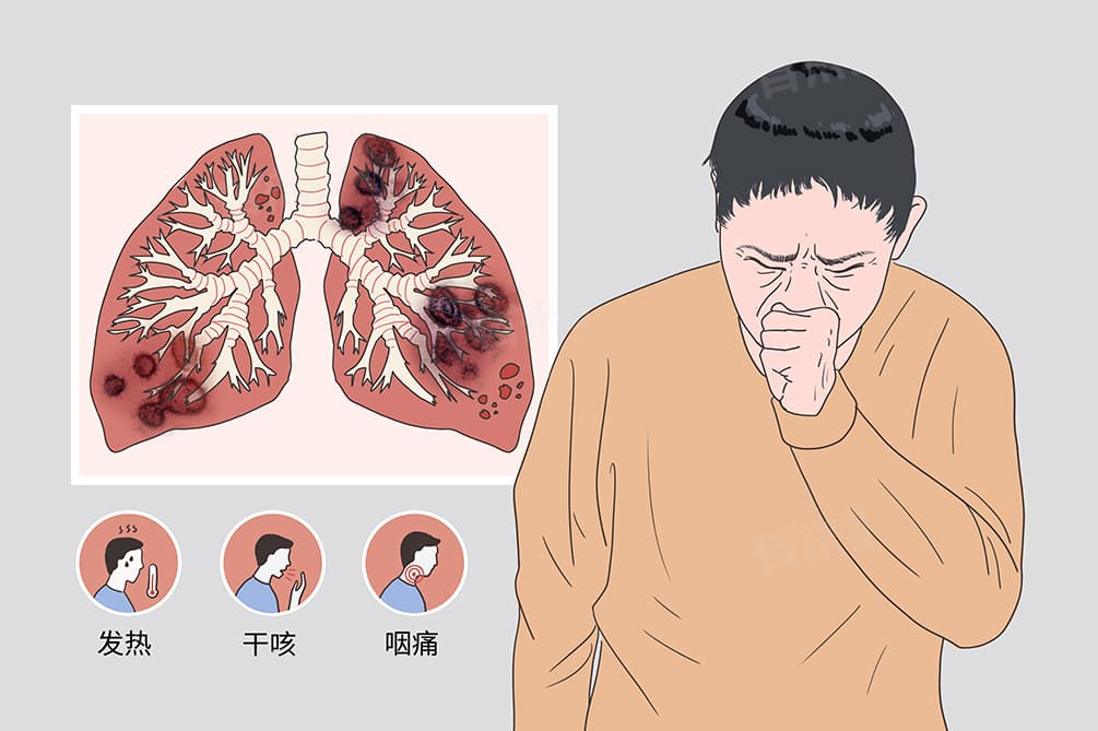 新冠20多种后遗症