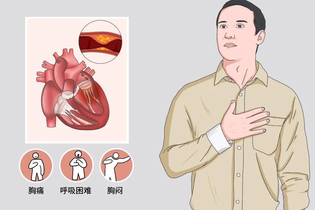 冠心病诊断标准
