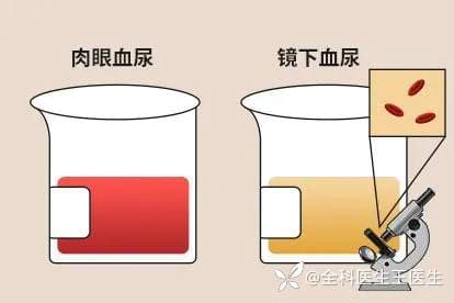 血尿≠尿血：揭开两者神秘的面纱