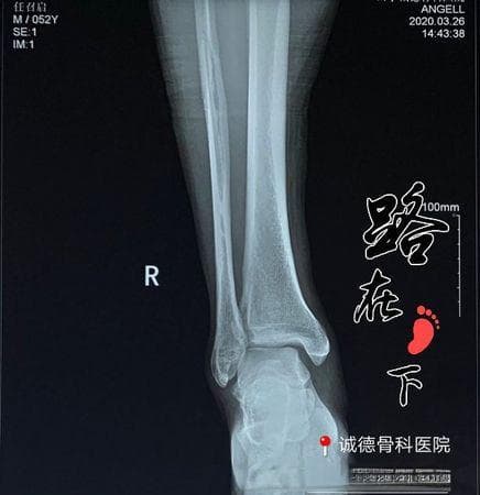 梦见脚踝断了的深层含义