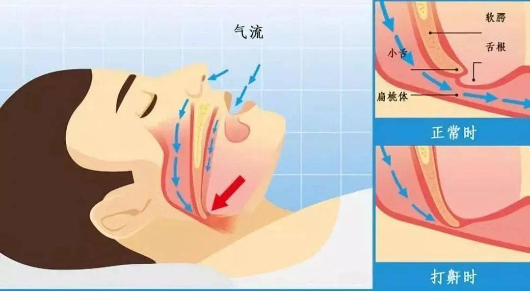 为什么会打呼噜，专家揭秘打鼾的健康真相