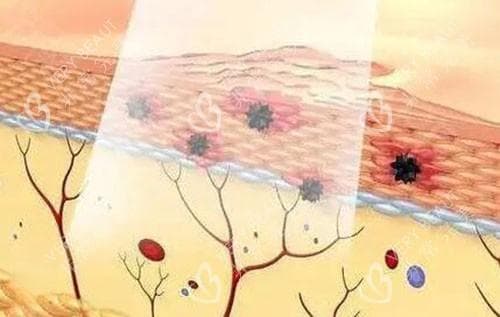 皮秒祛斑和激光祛斑有什么区别？作用原理+优势对比+术后维护建议统统奉上~