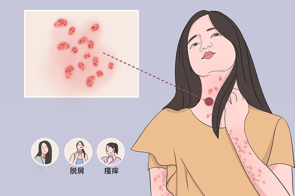 玫瑰糠疹的四个阶段