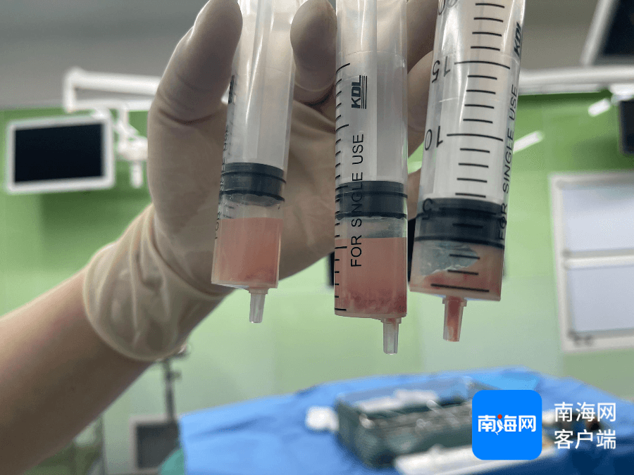 京琼专家联袂+多学科合作 海口市妇幼保健院首次实施超声引导下肝脓肿穿刺引流术
