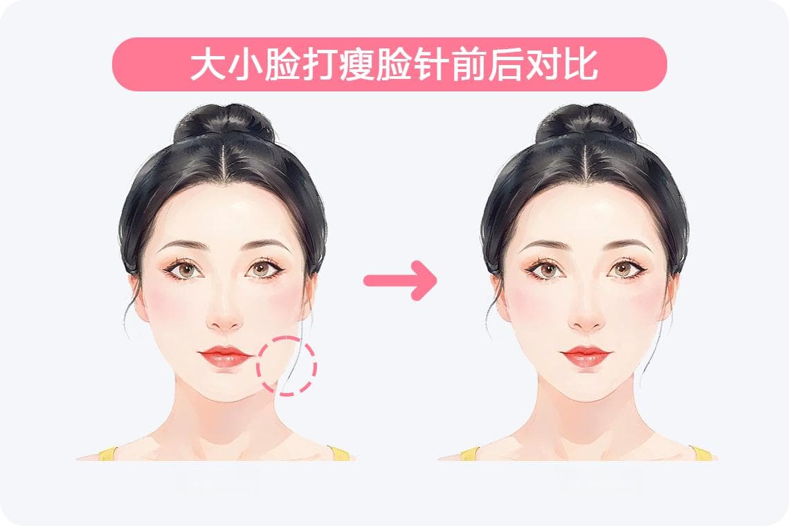 大小脸打瘦脸针有用吗