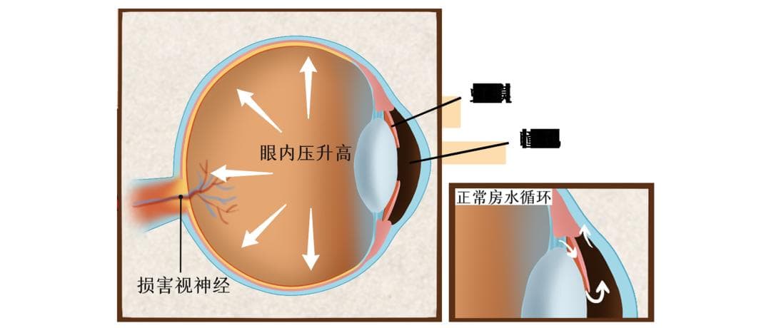 关灯玩手机当心青光眼！这种眼疾已成全球第二大致盲原因