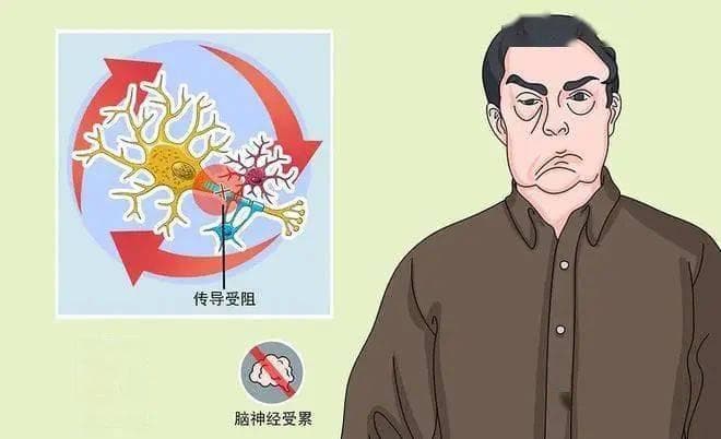 格林巴利治疗误区：避免走入歧途