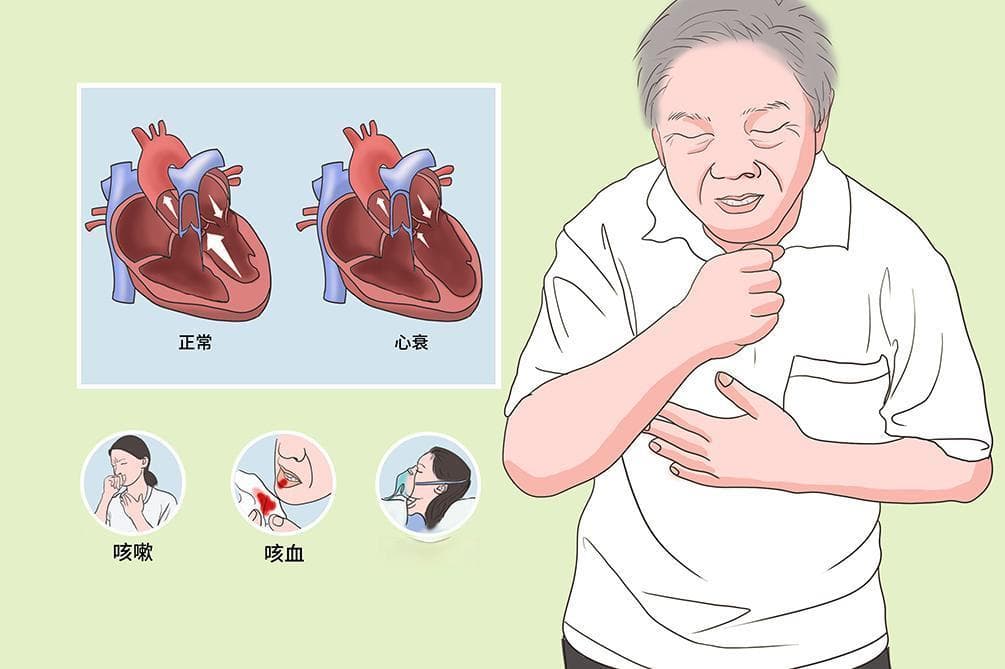 心衰的四个阶段症状