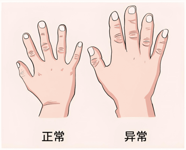 肢端肥大症：当身体悄悄"失控生长"