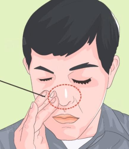 单侧鼻塞要警惕三种病