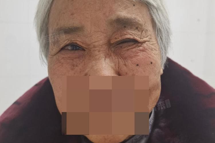 面肌痉挛怎么治