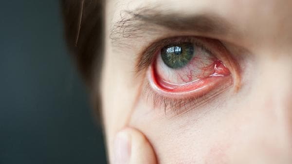 红眼病快速缓解秘诀：中医验方+日常预防，告别眼痛、眼肿、怕光！