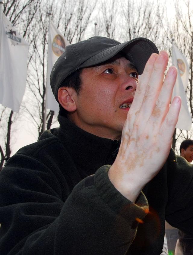 免疫系统异常致白癜风，不会传染但可治疗