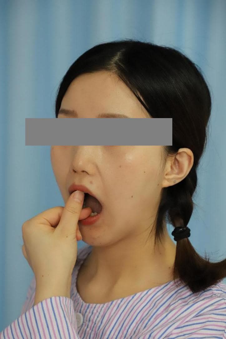 每天坚持一点点， 自信笑容多一点——张口功能训练