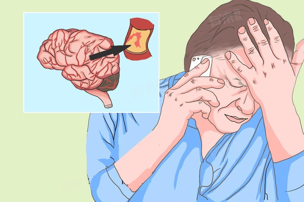 脑血栓前兆的十个表现