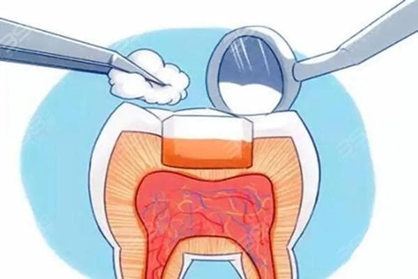 嵌体补牙和普通补牙的区别：从价格到使用寿命的全面解析