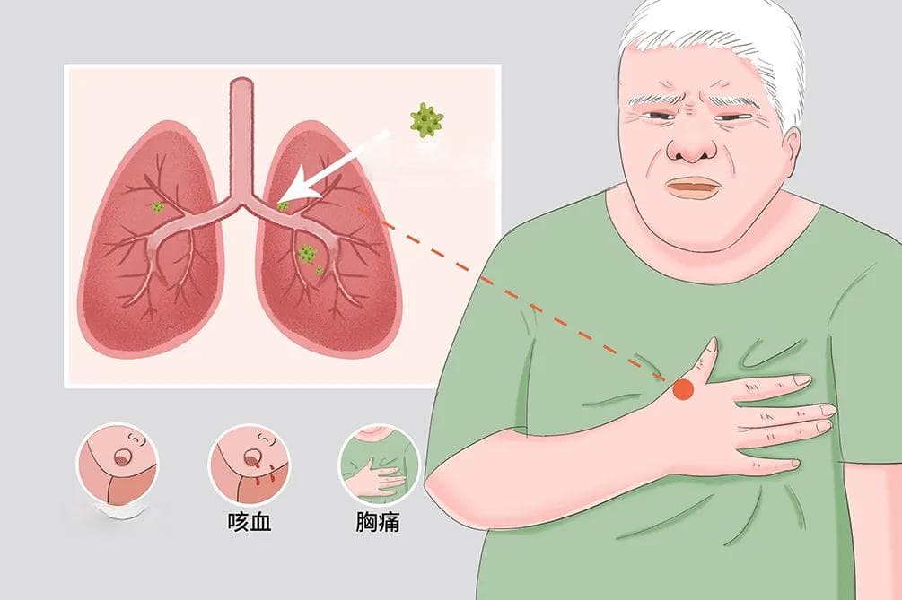 肺癌的分期TNM