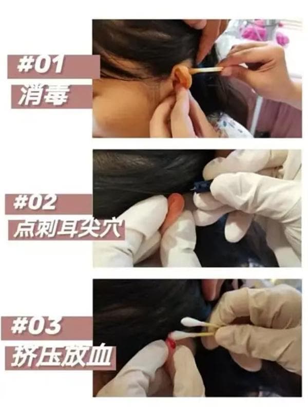 【眼科医院健康科普】高热莫惊慌，中医急症有妙招
