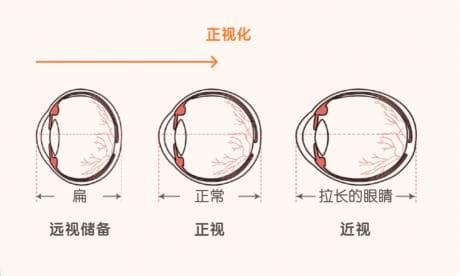 专家解读：远视储备与近视的关系，如何科学预防儿童近视？